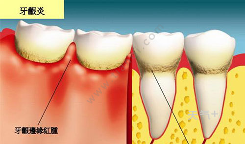 牙出血是什么病的前兆 牙龈出血与什么有关