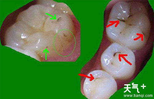 牙结石是不能通过刷牙的方式清洁掉的,只要通过洗牙的方式才能彻底