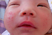 婴儿湿疹最佳治疗方法 护理湿疹的注意事项