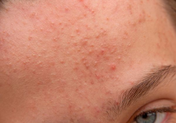 安安粉刺露是什么  安安粉刺露的使用方法