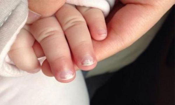 宝宝缺锌的症状 宝宝缺锌通常有什么表现