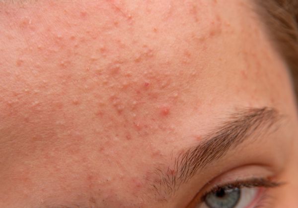 脸上有螨虫粉刺需要做什么 脸上有螨虫和粉刺怎么办