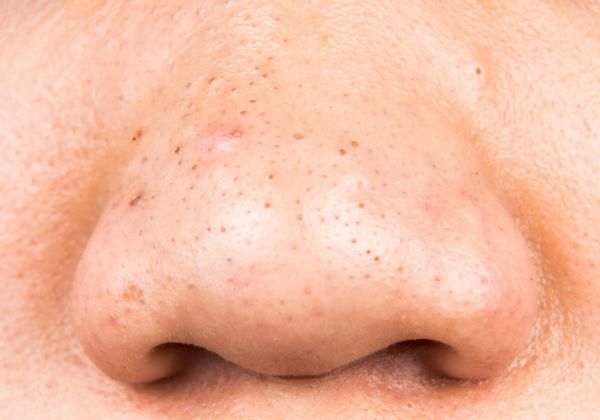 有闭口黑头怎么办 闭口黑头如何去除