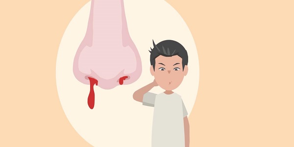 鼻子出血是什么原因 鼻子出血的处理方法