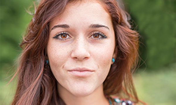 脸颊两侧长斑的原因 引起脸颊长斑的5大因素