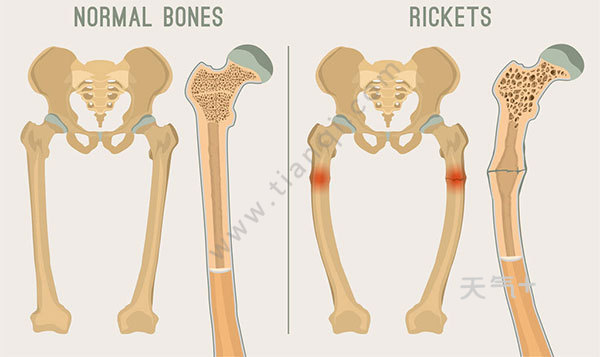 佝偻病的症状 这三种表现是佝偻病的征兆