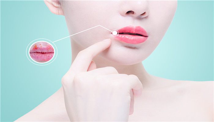 嘴唇干裂脱皮是什么原因 嘴唇如何保养