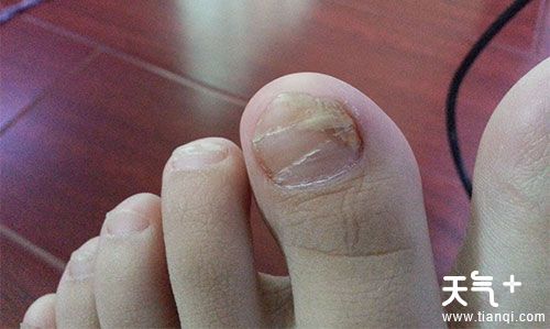 灰指甲的初期症状 轻微灰指甲的症状图片