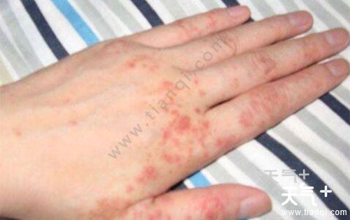 过敏性湿疹的诱因是什么 过敏性湿疹症状图片