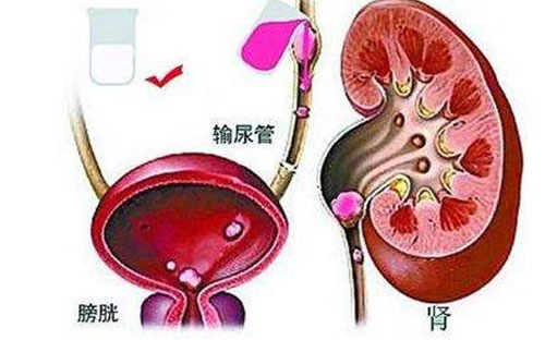 女性腺性膀胱炎图片图片