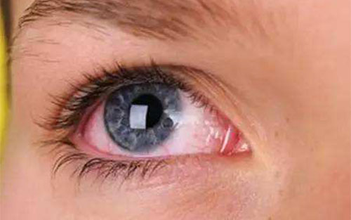 眼睛红血丝是什么病 眼睛红血丝形成的原因