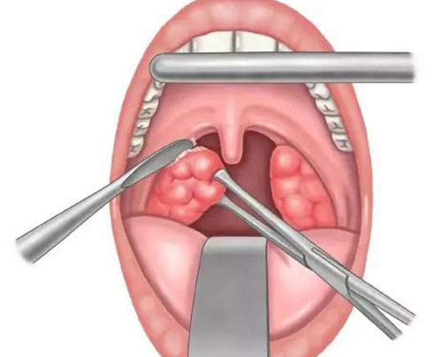 春季扁桃體發作扁桃體切除後遺症