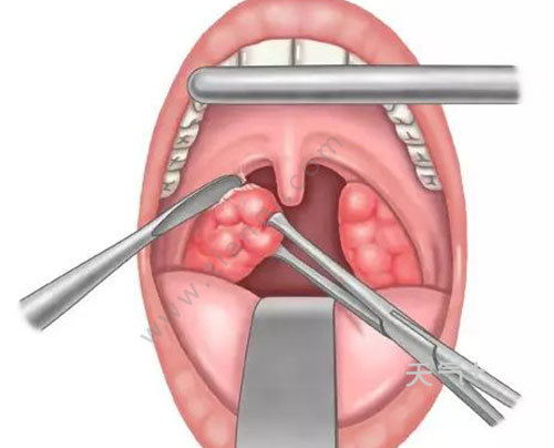 扁桃體切除後可能會有以下情況發生: 1,出血:一般扁桃體切除手術後的
