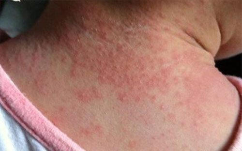 湿疹是什么 湿疹和热疹的区别图片