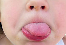 舌苔厚白是疾病的征兆吗 舌苔厚白是什么原因