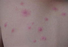 成人水痘传染吗 水痘的症状图片