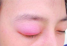 上眼皮肿是怎么回事 眼皮肿要注意什么