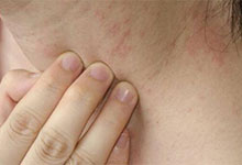 皮肤过敏症状图片 怎样预防春季皮肤过敏