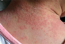 湿疹是什么 湿疹和热疹的区别图片