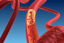 胆固醇高有什么危害 总胆固醇偏高的原因