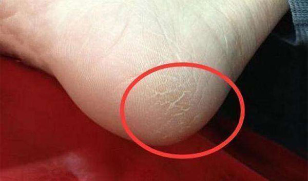 脚后跟干裂是什么原因脚后跟干裂保养护理事项