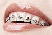 戴牙套合适年龄 戴牙套的注意事项
